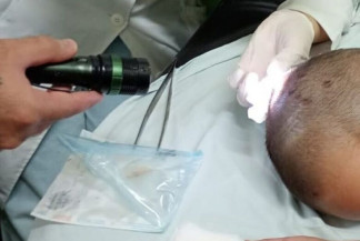 Menina de 7 anos é internada às pressas com larvas na cabeça em Dourados